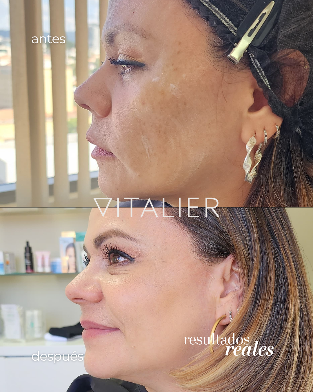 Antes y después de tratamiento de manchas y textura facial en VITALIER, Tegucigalpa