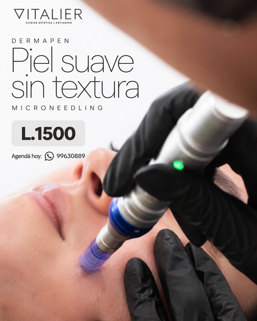 Sesión de Dermapen microneedling facial en VITALIER Clínica Estética, Tegucigalpa